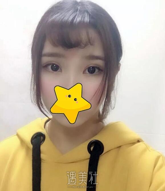 叶信海双眼皮案例：我还是大眼睛好看呐!