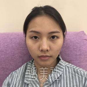 龚涛,隆鼻