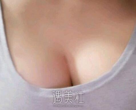 李朕,丰胸