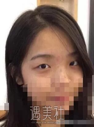 驻马店美兰德整形医院怎么样?李小草医生双眼皮案例展示!