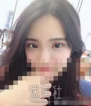驻马店美兰德整形医院怎么样?李小草医生双眼皮案例展示!