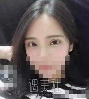驻马店美兰德整形医院怎么样?李小草医生双眼皮案例展示!
