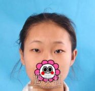孙强双眼皮案例来袭：再也不是“小眯眼”~ width=