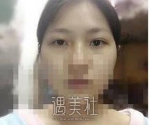 朱武根双眼皮案例，小姐姐公布逆袭经历 width=
