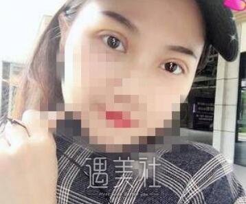 朱武根,双眼皮