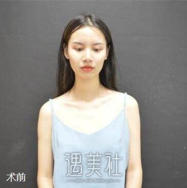 高柳进,隆胸