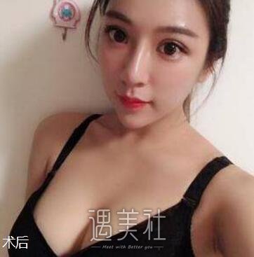 高柳进,隆胸