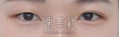 孙强双眼皮案例：一个月逆袭女神 width=