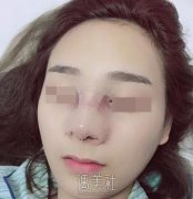 邢台人民医院整形科隆鼻技术如何?能人见人爱的果吗? width=
