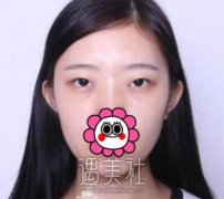 曹阳双眼皮案例上线：“小眯眼”女孩也会迎来春天~ width=