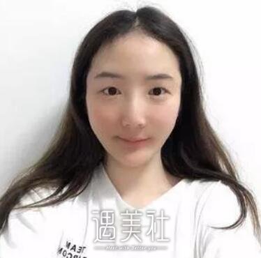 张黎,双眼皮