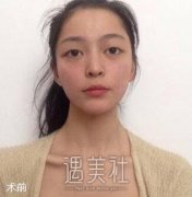 张恒术双眼皮案例：卧槽！牛逼！ width=