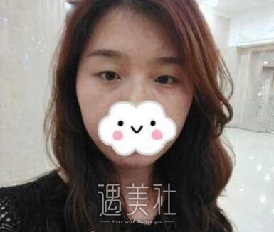 杨亚益,双眼皮