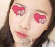汪福强隆鼻案例：三个月恢复记录+图片 width=