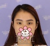 张恒术双眼皮案例分享，单眼皮看了会心动哦~ width=