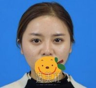 余娇隆鼻案例：终于可以侧颜杀辣 width=