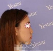 黄文隆鼻案例分享 打造立体精致颜 width=
