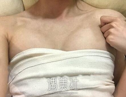 李发成,自体脂肪丰胸