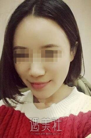 南宁美丽焦点整形医院正规吗?做面部脂肪填充果如何?