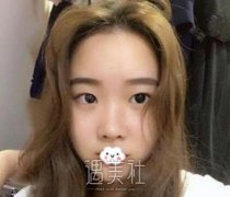 吴振双眼皮案例：内附大量真实恢复图，速来围观 width=