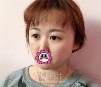 薛志强 双眼皮案例 纠结的来康康我的果叭 width=