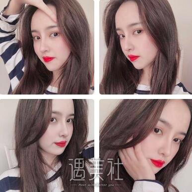 李俊,隆鼻