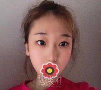 王国明双眼皮案例 我做的全切开扇形 width=
