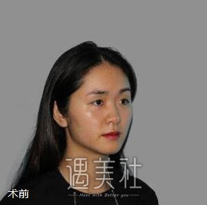王旭明,隆鼻