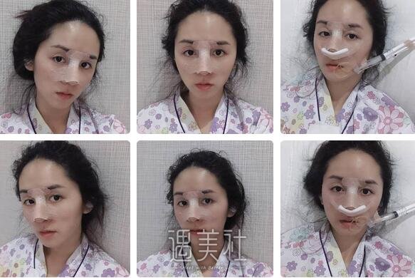 王旭明,隆鼻