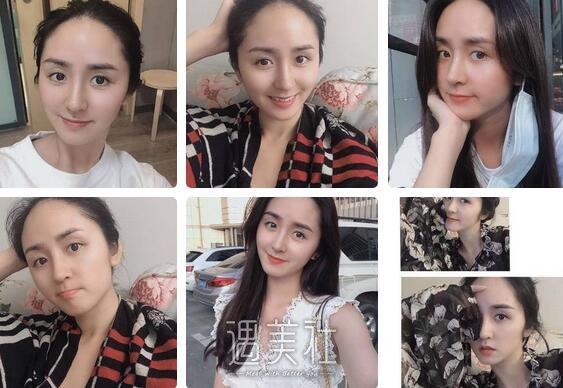 王旭明,隆鼻