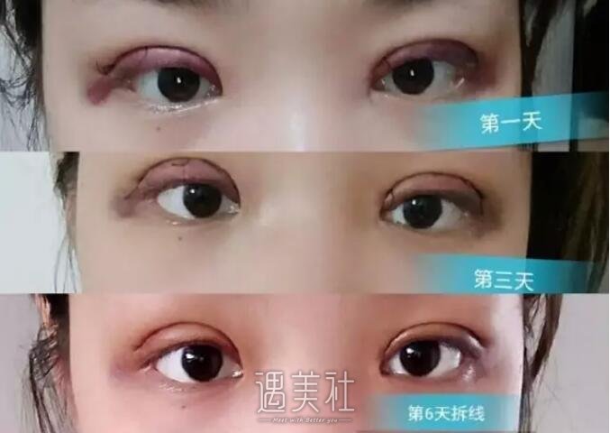 通化吴学军美容医院双眼皮技术怎么样?2020年案例及价格表一览~