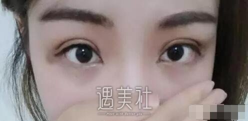 通化吴学军美容医院双眼皮技术怎么样?2020年案例及价格表一览~
