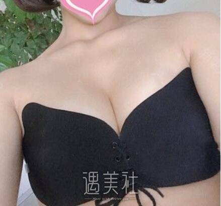 王明利,自体脂肪丰胸