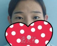 吴溯帆双眼皮案例：果有超出预期哦！ width=