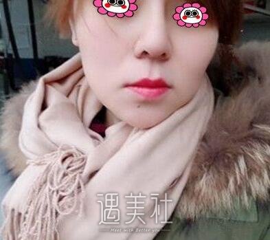 王旭明,隆鼻