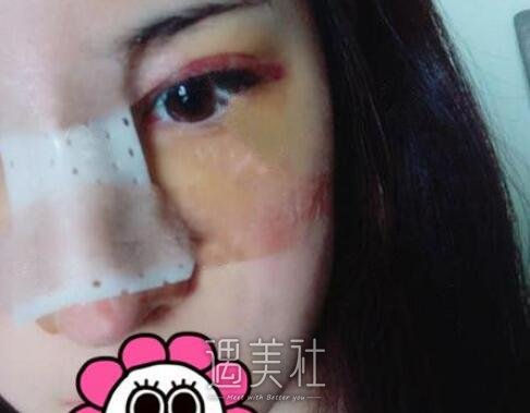 牛永敢,隆鼻