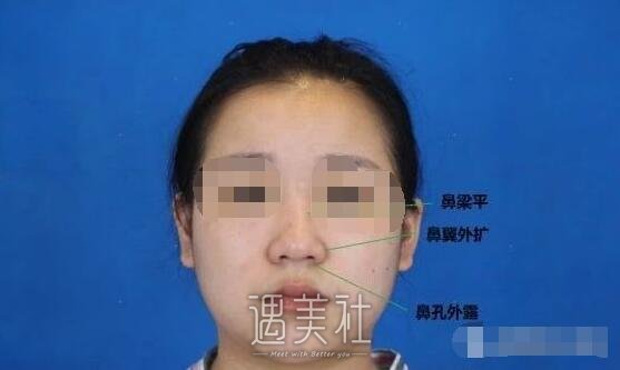 于立民做鼻子好吗|于立民隆鼻案例硬核证明~