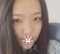 王先成隆鼻案例 出门都有小哥哥问我要微信 width=