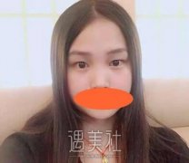 王国明双眼皮案例 全切平行还挺适合我 width=