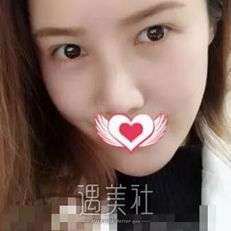兰州陆军总院整形科双眼皮怎么样?案例及果图一览~