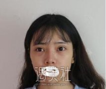 张正文隆鼻案例  就靠这个逆袭了 width=