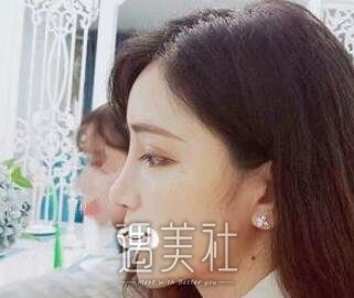 张正文,隆鼻