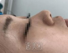 金海坤隆鼻案例：颜值的重要性远超出预想 width=