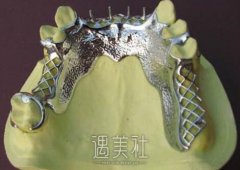 纯钛烤瓷牙和全瓷牙哪个好?一起来科普下哦~ width=