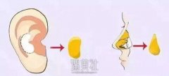 软骨垫鼻子果大概能维持多久呢?下周想去做了~ width=