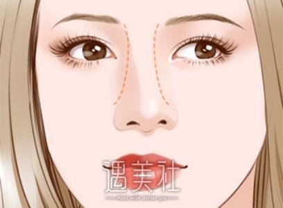 成都,歪鼻矫正