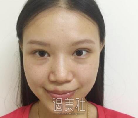 成都,米兰柏羽,隆鼻