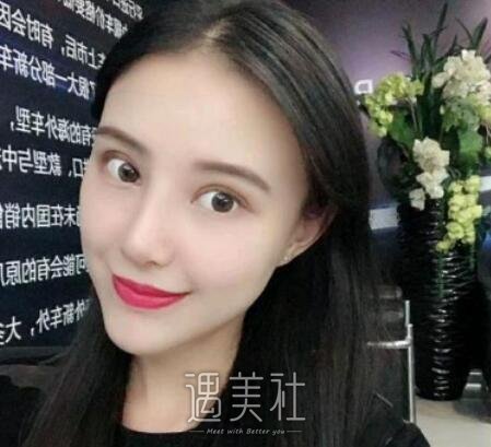 成都,米兰柏羽,隆鼻