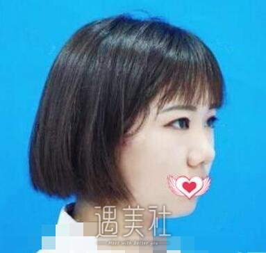 徐航,隆鼻