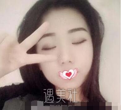 徐航,隆鼻